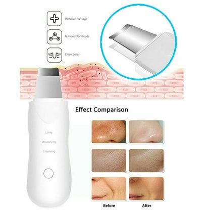 Ultrasonic Skin Scrubber Face Spatula Blackhead Remover